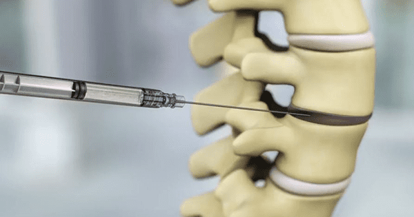 DiscGenics IDCT Injection