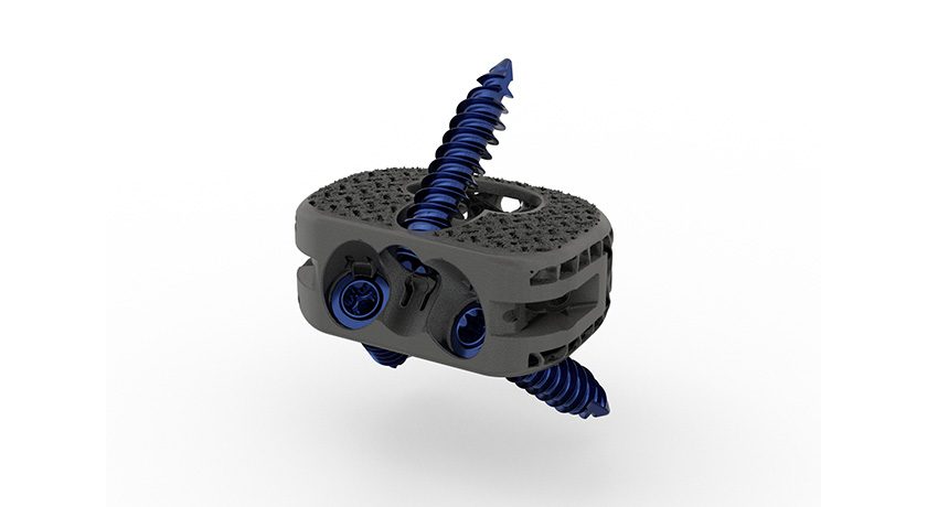 Orthofix Medical WaveForm A 3D Printed Anterior Lumbar Interbody