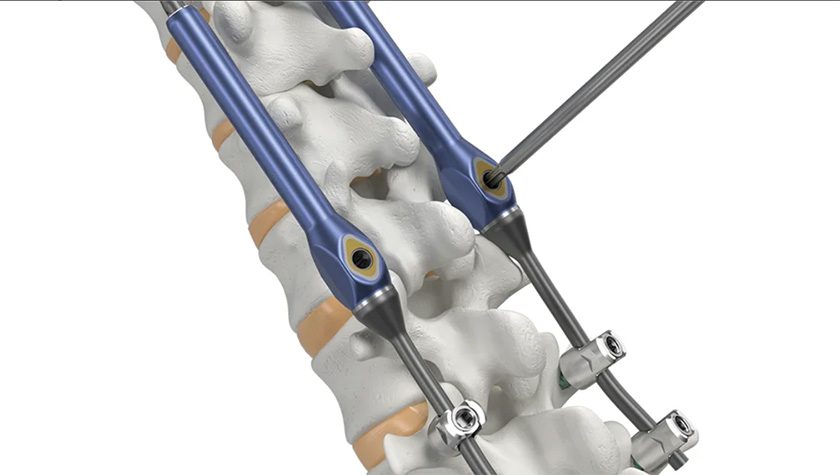 Globus Medical Marvel Growing Rods