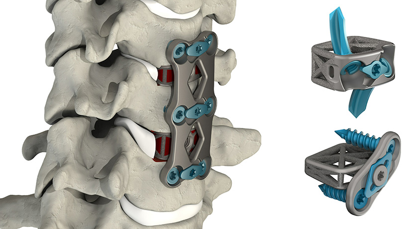 4WEB Medical Cervical Spine Plating