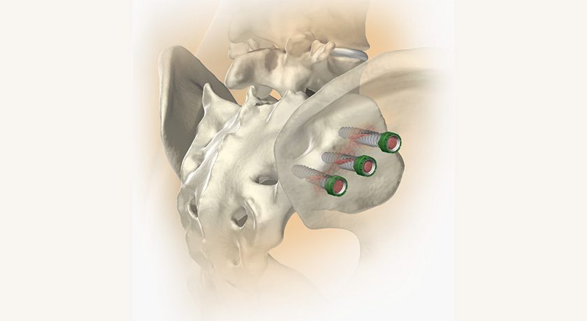 Alevio Spine SI-Cure
