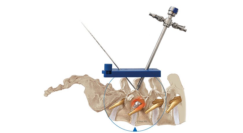 joimax ILESSYS Biportal Interlaminar Endoscopic Surgical System