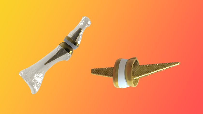 Anatomic Implants Great Toe Joint Replacement