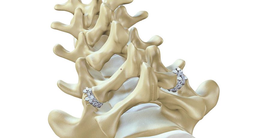 ZygoFix zLOCK Lumbar Facet Fixation