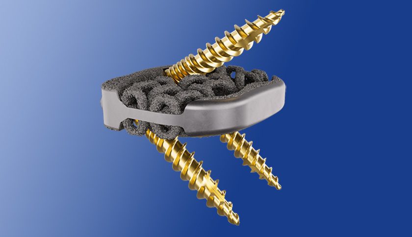 Camber Spine SPIRA-A Integrated Fixation