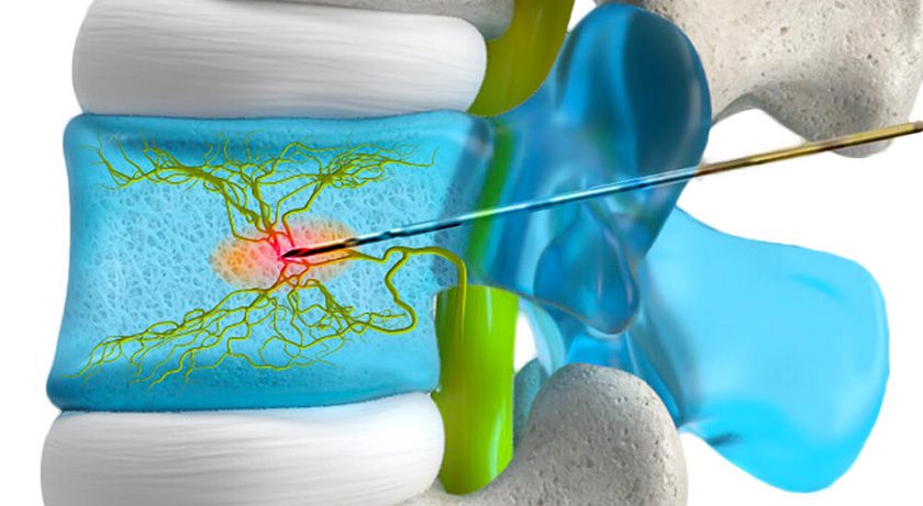 New4Med Basivertebral Nerve Ablation