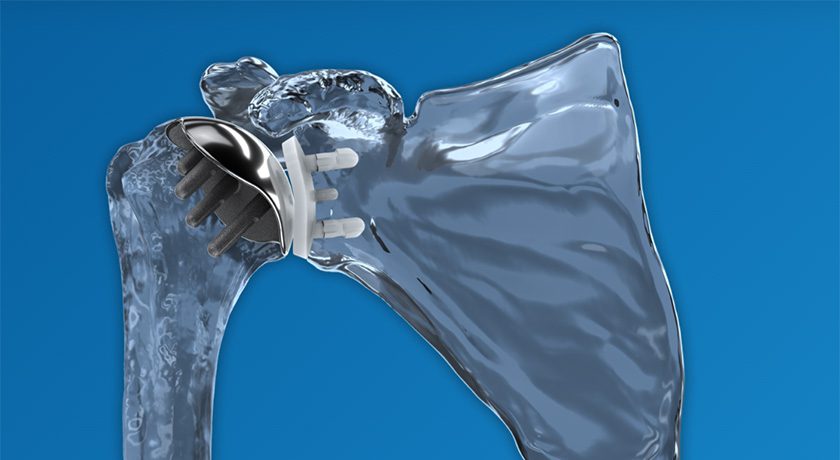 Catalyst OrthoScience Total Shoulder