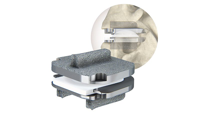 Centinel Spine prodisc C Nova