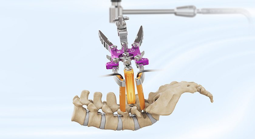 TeDan Surgical Innovations ML3 MIS Lumbar Surgical Access