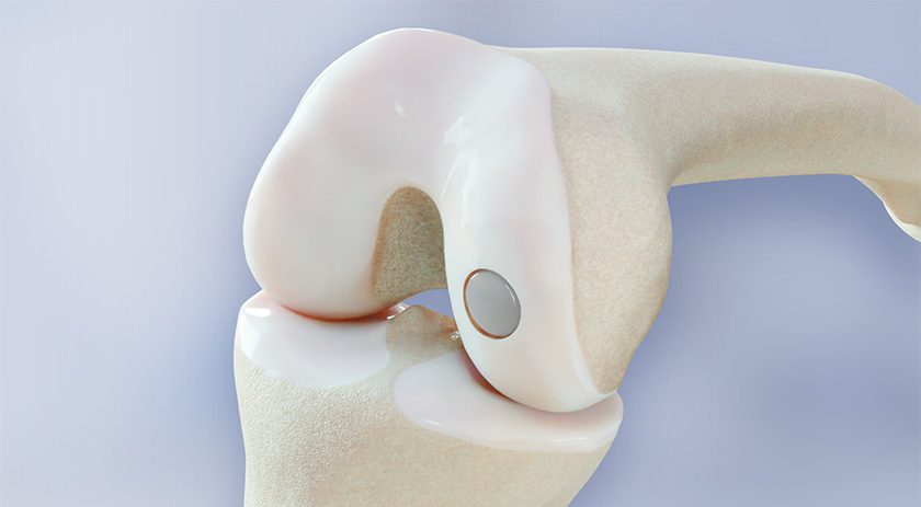 BioPoly Partial Resurfacing Knee Implant