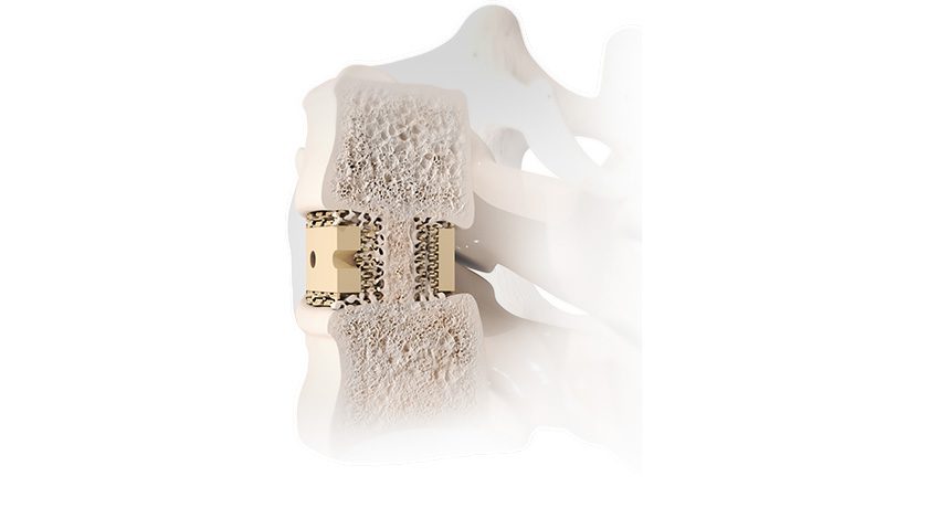 Curiteva Inspire Spinal Implant