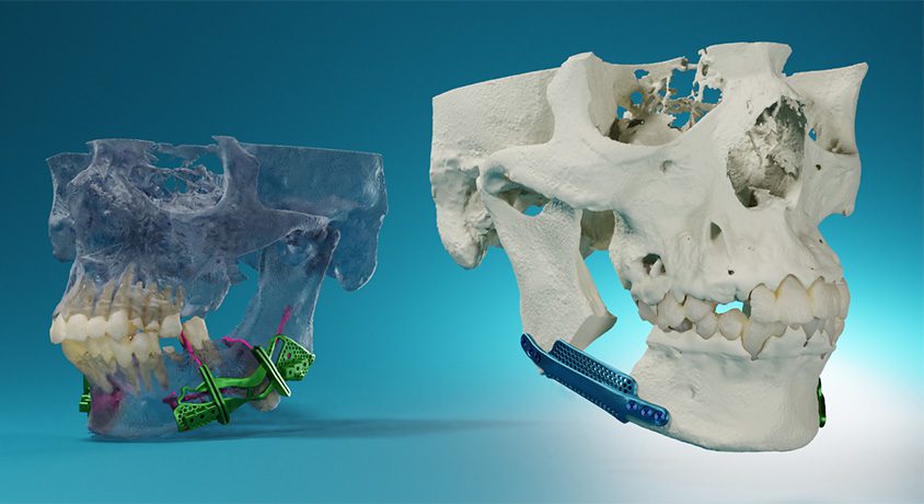 MedCAD 3D-printed titanium products