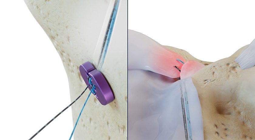 Native Orthopaedics Native Root System